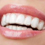 Teeth with Whitening Tray