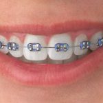 Metal Brackets