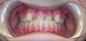 Case 1 - Before Treatment