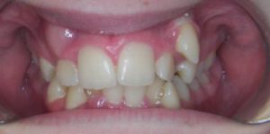 Case 3 - Before Treatment